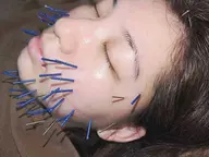 癒着剥がし美容鍼+小顔矯正