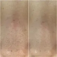 《毛穴の黒ずみ&ニキビケア》毛穴洗浄×ハーブピーリング 80分 デコルテ＆ショルダー＆ヘッドマッサージ付