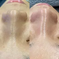 ハイドラフェイシャル美肌コース(90分) ¥15,000→¥7,500