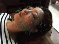 小顔になれる美容鍼50本ヘッドマッサージ付き お顔ダイエット!むくみ解消、トーンUP、化粧ノリ抜群!