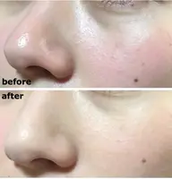 ミニモ限定❣️ミニモでご予約の方限定で超音波の毛穴洗浄をプレゼント🎁