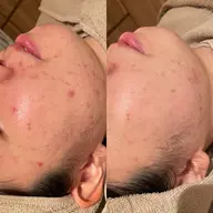 【💛期間限定💛】ニキビ、肌荒れでお悩みの方におすすめ✨ハーブピーリング＋超高保湿カスマラパック🌿