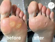 トータル角質ケア　魚の目個数制限なし　(魚の目・タコ・かかと足裏全体ケアします)※初めての方にオススメ