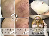 【ニキビ・毛穴特化◎】ハーブピーリング【剥離なし】天然100%国産ハーブ×ヒト幹細胞配合