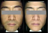 メンズ ヒゲ脱毛【2回目以降のリピート】 ヒゲを無くすと清潔で若く見える