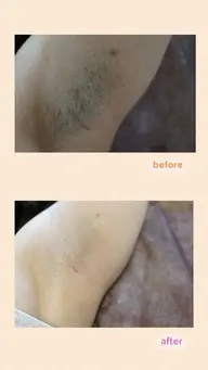 脇（両脇） ※自己処理なしでお越しください.