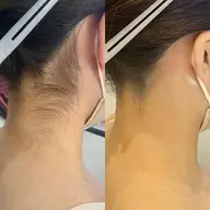 ✨シュガーリング脱毛　うなじ