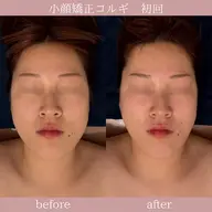 ミニモ割✎𓈒𓂂𓏸🉐小顔矯正コルギ＋上半身ほぐし付👏✨韓国アイドル顔🇰🇷《エラ張り・くすみ・ハチ張り◎》