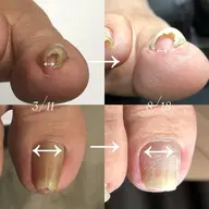 〈B/Sブレイス〉巻き爪矯正