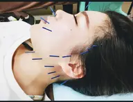 美白ケア＋美容鍼