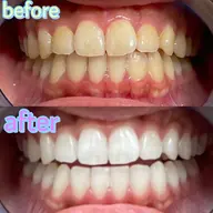 🌸人気No.1🌸【4/14来店限定】🔥圧倒的効果🔥通常の6倍照射💖 14800円→7800円