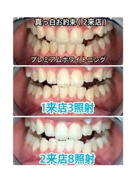 【最安最白❤️‍🔥】真っ白白プレミアムホワイトニング30分×4来店コース 19,800円