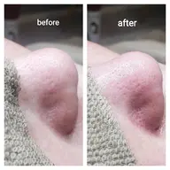 毛穴エクストラクション✨メンズOK　リピーター様