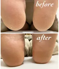 足裏ガザガザ踵の角質除去🦶ツルふわコース