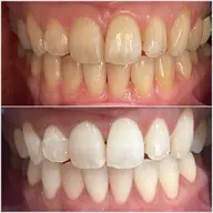 【毎月3名限定】Before Afterの写真投稿と口コミで3980円！平日限定ホワイトニングのみのモニターコース🍓