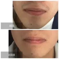 【人気NO.1！毎朝が楽に】メンズヒゲ脱毛 ¥3500