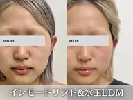 《ミニモ学割U24 》💛【小顔/二重あご/お顔の脂肪に◎】◆インモード× 水玉リフティング
