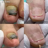 【足の分厚い爪・深爪再生補正】思わず隠したくなるその爪…😢諦めないでください💡正常な爪へ💁♀️