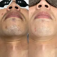 青ひげ解消！ヒゲ脱毛👔