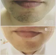 メンズ脱毛おためし！脚、お腹、腕、髭など選べます！カウンセリングして自分に合うかぜひ体感ください！