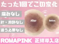 【黒ずみ/メラニンケア】ローマピンク無料カウンセリング