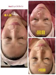 韓国で大ブーム☆　最新RedShot 脂肪にアプローチ　フェイスラインすっきり小顔へ！