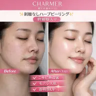 【今月限定人気No1★医師推奨/本格肌改善】幹細胞入りの独自のハーブピーリング×ハイドラ毛穴洗浄　水光肌コース