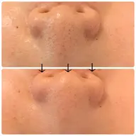 小鼻の黒ずみに☆小鼻ハーブピーリング