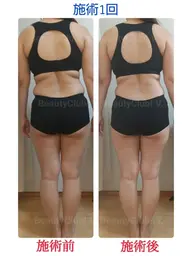 【結果重視】痩身エステ～筋膜リリース～