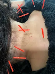 【整体×鍼灸】🪡Wアプローチで不調を根本改善✨骨格調整＋鍼灸で、痛み・コリ・自律神経の乱れを徹底ケア！