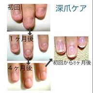 【深爪ケア】（初回ホームケア用品付き）