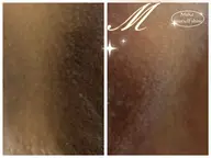 4月限定デリケートゾーンiメラニンケア80,000→¥60000