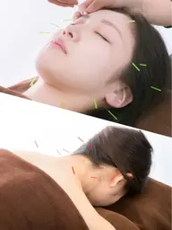 🌸美容鍼+首肩鍼+首肩頭マッサージ🌸　120分