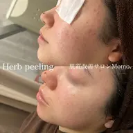 【人気No.1】剥けないハーブピーリング🌿スチーマー洗顔&高保湿パック付