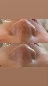 【人気menu♡】毛穴&くすみ改善コース