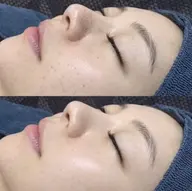 【最新ピーリング】めくれない、一度で驚きの効果も即実感♪シワシミたるみや肌荒れニキビ肌にも◎