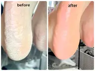 ツルふわ✨フット角質ケア