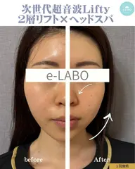 【脱・二重アゴ】Lifty２層リフト×ヘッドスパ◆横顔Vライン形成