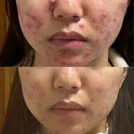 【フェイシャル】無添加ハーブ&漢方ピーリング🌿敏感肌/脂性肌/ニキビ肌にも✨