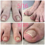 巻き爪 解放 2指（両足親指）