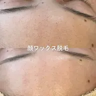 4/15​〜​19日までの限定価格🌸顔の産毛が気になる方に◎顔ワックス脱毛【口コミご協力いただける方】