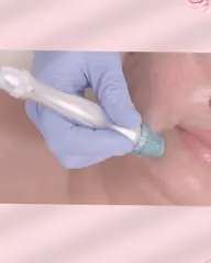 【モデル価格】毛穴吸引×酵素フェイシャルエステ