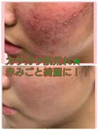 痛み有り💦DTあり‼️でも実感🩷ノーマルハーブピーリング＆ハイドラ毛穴洗浄🌿しつこいトラブルにお困りの方