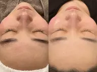 【エステ版ダーマPEN】新メニュー登場☆水光ダーマジェット!初回限定￥11,000