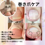 5名様限定✨巻き爪ケアモニター(ケア+牽引+チップ装着)親指1本