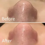 【平日16:00まで初回】ハイドロ毛穴洗浄×イオン導入 ¥11,000→¥ 5,980【口コミ割】