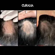 韓国最新薄毛対策(1回¥15,000を月2回来店メニュー月2回で¥22,000)