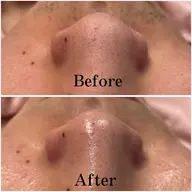 【🌟4/20限定🌟】お顔剃り＋全顔毛穴洗浄＋ハイドロジェリーマスク