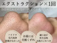 毛穴エクストラクション鼻のみ