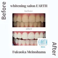 【お試しプラン】美白ホワイトニング10回コース　20分×10回　基本的には5日分